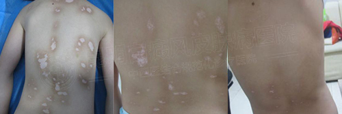 又到一年开学季 别让白斑击垮孩子