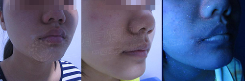 又到一年开学季 别让白斑击垮孩子