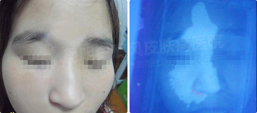 9月隐性白斑专项检测月 精准化智能定位白斑病灶