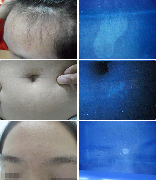 9月隐性白斑专项检测月 精准化智能定位白斑病灶