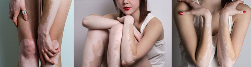 8.2全国白癜风防治日 我们与你携手抗白