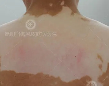 白癜风分型分诊很重要 避免病情反反复复