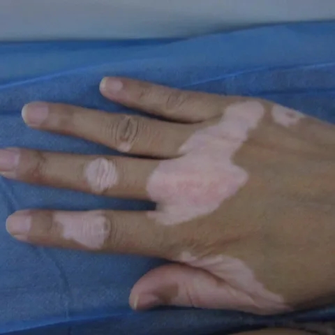 白癜风分型分诊很重要 避免病情反反复复