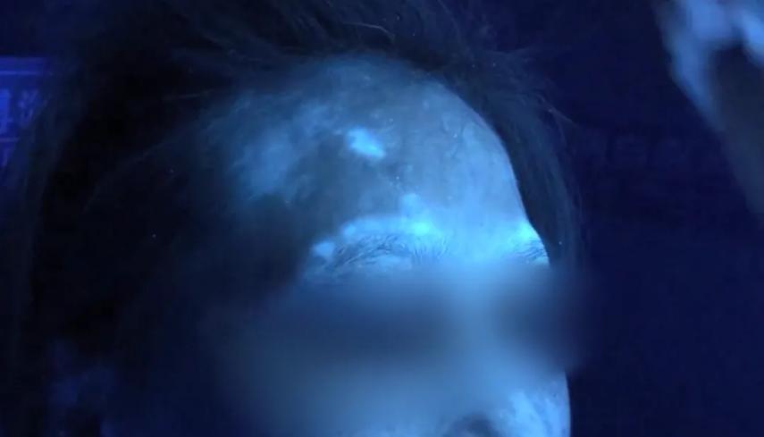 白癜风分型分诊很重要 避免病情反反复复