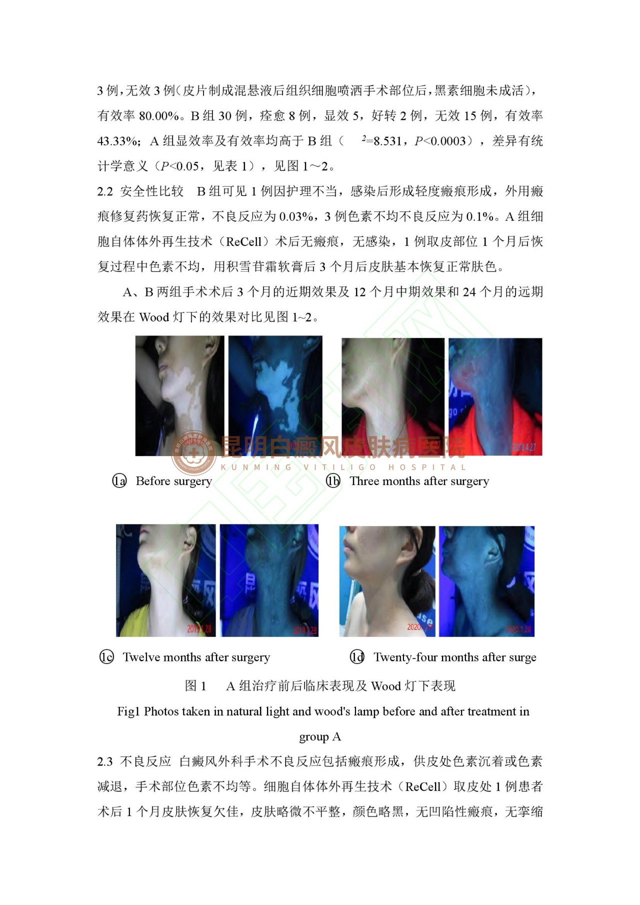 学术成果|昆明白癜风外科技术科研论文成功刊登《中国皮肤性病学杂志》